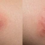 Espinillas XXL infectadas: por qué Sac Dep Spa revela lo que tu dermatólogo nunca te mostrará