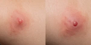 espinillas xxl infectadas sac dep spa